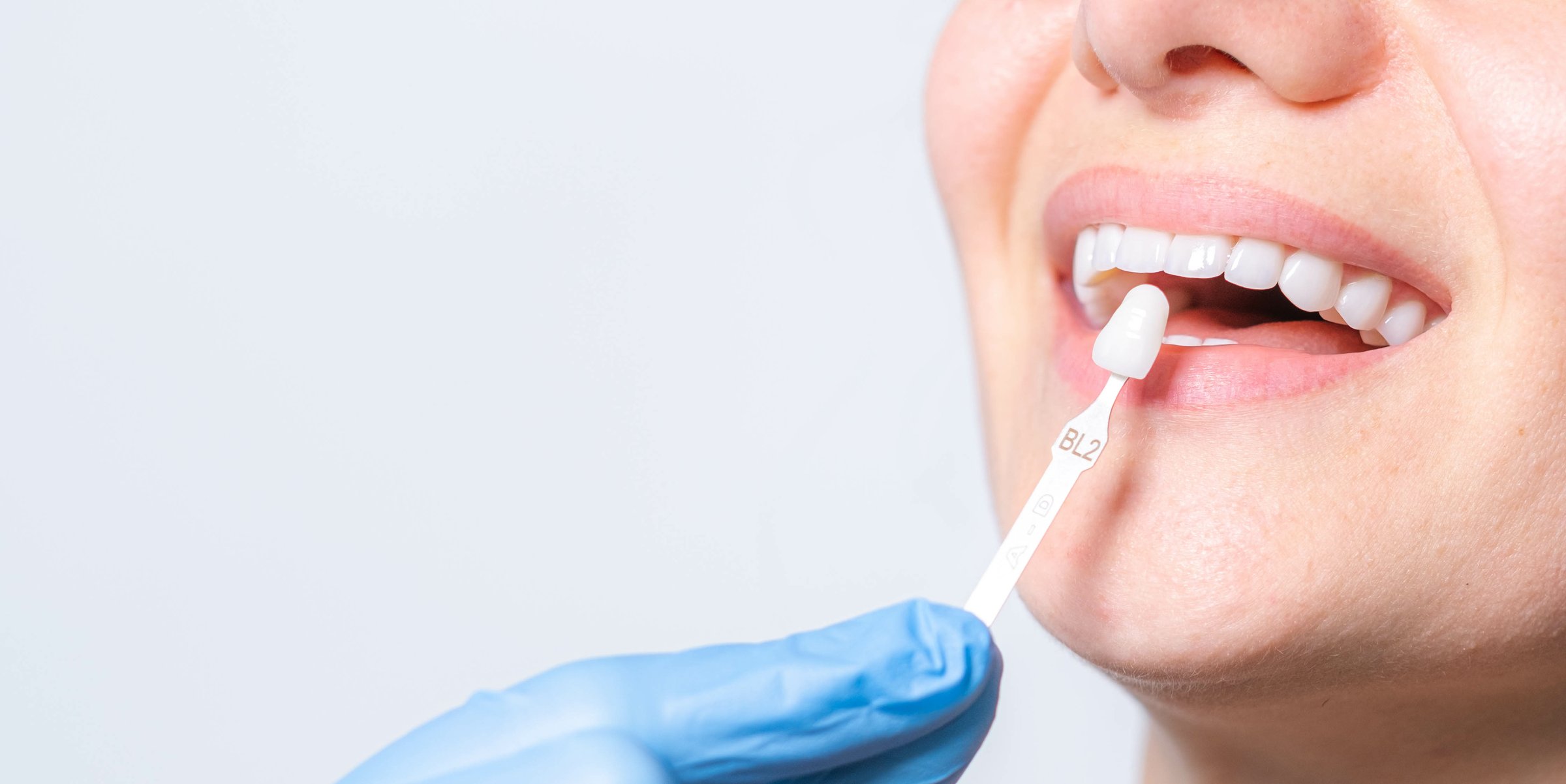 Strahlend weißes Lächeln mit Farbskala – ästhetischer Zahnersatz und Veneers in der Praxis Zahnschön